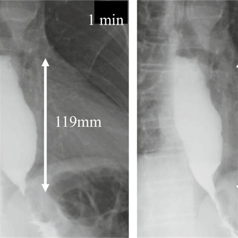 Timed Barium Esophagogram Results Before The Second Treatment 119 Mm