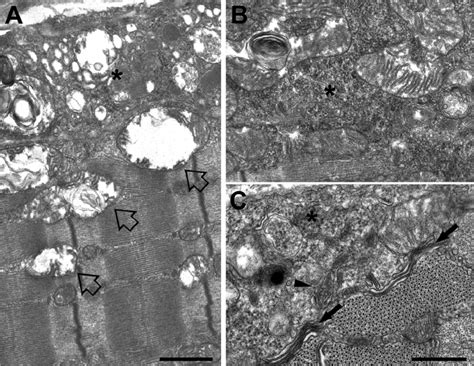 Accumulation Of Amorphous Materials And Membrane Bound Inclusions A