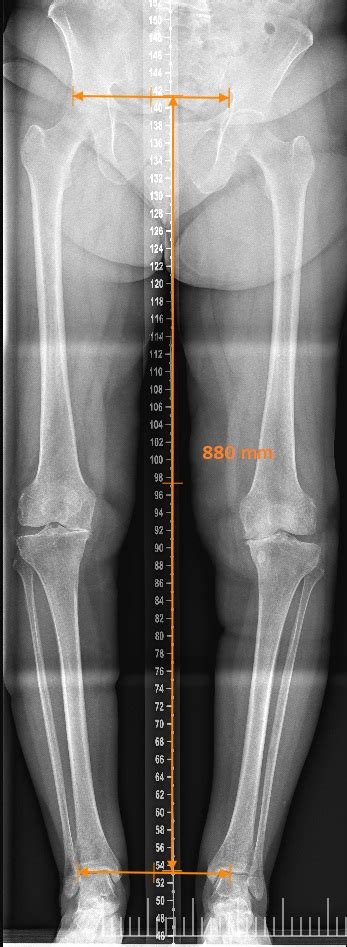 Fig Radiograf A Panor Mica De Miembros Inferiores Con La Cual Se