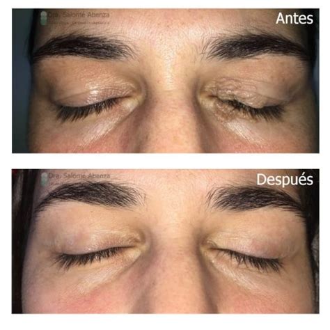 Blefaroplastia Superior Y Utilizaci N De Injertos De Piel Para