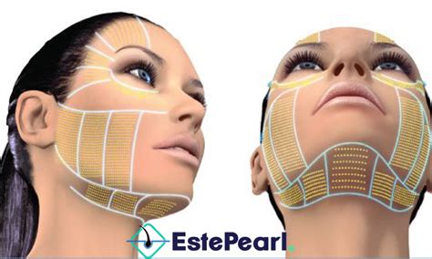 Ultherapy Nonsurgical Facelift Este Pearl