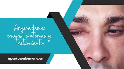 Angioedema Causas S Ntomas Y Tratamiento Apuntes Enfermer A