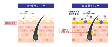 フケは乾燥肌に現れやすい？原因と対策を押さえていつも清潔な頭皮に メディプラス乾燥予防研究所