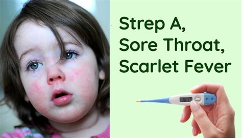 Streptococcus A Sore Throats And Scarlet Fever Tracey Campbell