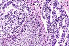 Adenosquamous carcinoma of the lung - Libre Pathology