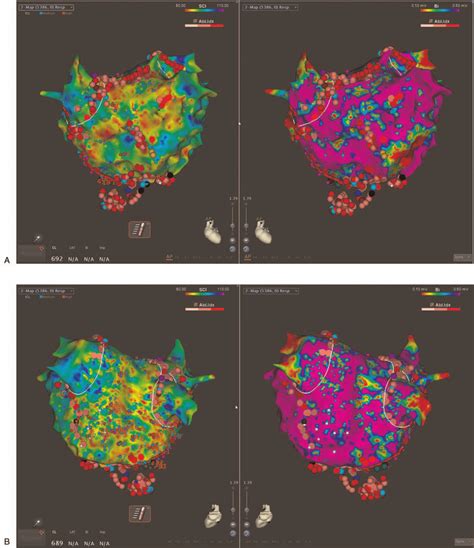 Examples Of Electroanatomic Maps Of A Low Voltage Complex Fractionated