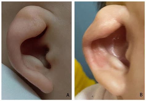 Ear Molding For Congenital Auricular Deformities Efficacy And Factors