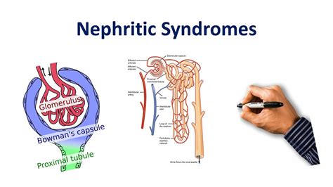 Nephritic Syndrome Made Simple Youtube