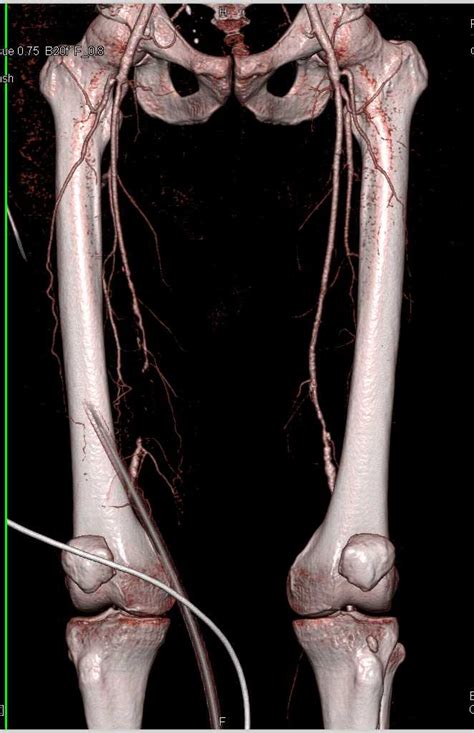 Femoral Artery Occlusion