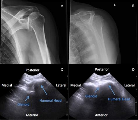 Just The Facts Point Of Care Ultrasound In The Management Of Shoulder Dislocations Canadian