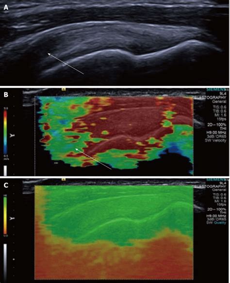 Longitudinal Shear Wave Elastography Of A Normal Supraspinatus Tendon