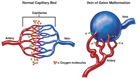 Vein of Galen Malformation Support Group NZ - About Vein of Galen | Supportive, Veins, Character