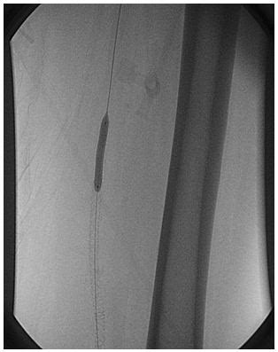 Stent deployed in superficial femoral artery | Download Scientific Diagram