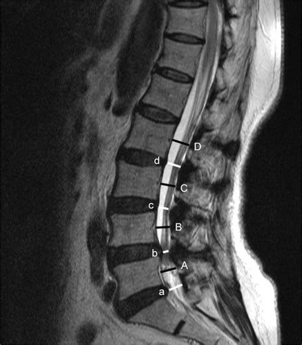 Full Article Predictive Factors Of Symptomatic Lumbar Canal Stenosis In Patients After Surgery