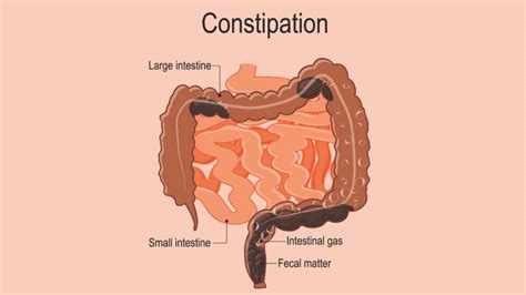 Constipation Causes Diagnosis And Natural Treatments 1md Nutrition