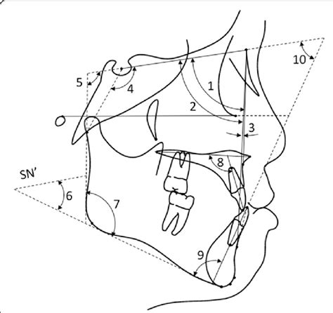 Angular Measurements 1 Sna Angle 2 Snb Angle 3 Anb Angle 4 Download Scientific