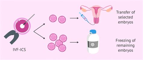 Frozen Embryo Transfer Fet In Ivf