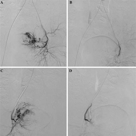 Bilateral Uterine Angiography Before And After Uae A C Prior To Uae