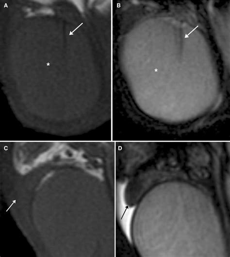 Normal Mri Anatomy Of The Scrotum Normal Testicular Signal Is Low To