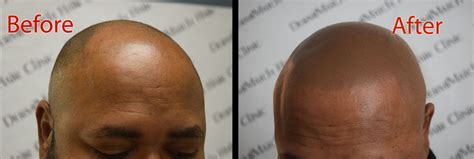 Scalp Aftercare Dos Dermmicro Scalp Products