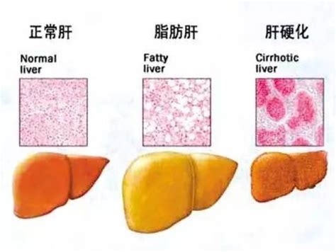 脂肪肝和正常肝比较图 脂肪肝图片 各级脂肪肝的图片 第3页 大山谷图库