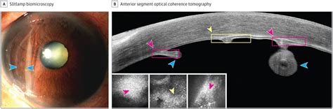 Endothelial Cell Morphology Surrounding A Descemet Membrane Break