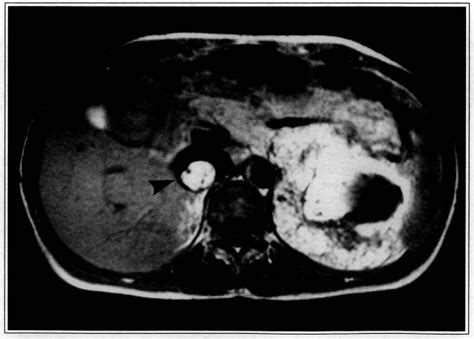 Figure 1 From Inferior Vena Caval Tumor Thrombus From Renal