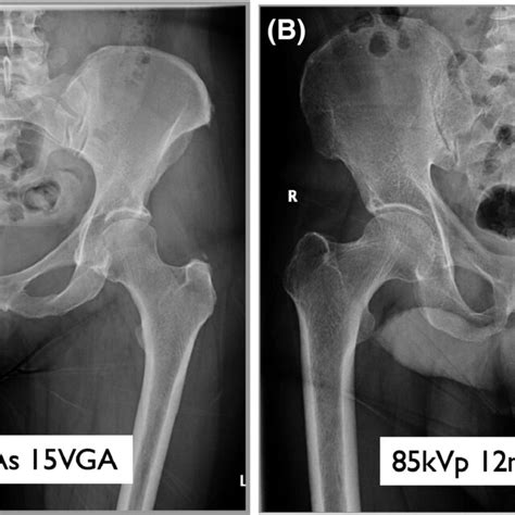 Lateral Lumbar Spine Radiographs A Low Kvp Group 3 B High Kvp