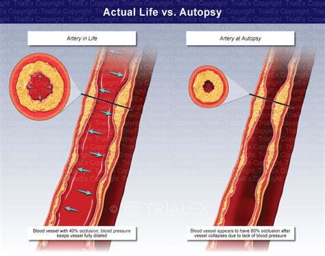 Actual Life vs. Autopsy - Trial Exhibits Inc.