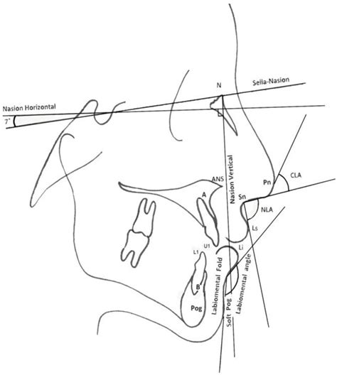 Cephalometric Landmarks And Reference Planes Download Scientific Diagram