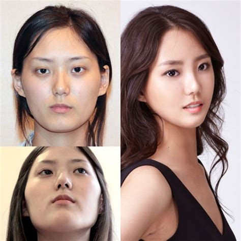 Korean Skin Botox Before And After Before And After