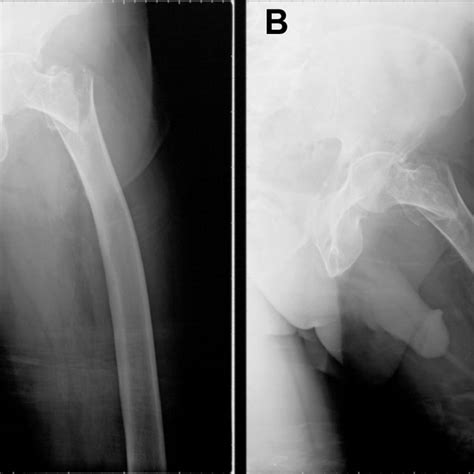 Postoperative 12th Month Posteroanterior And Lateral X Ray Of An