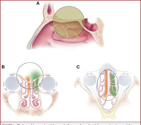 Figure From Endoscopic Endonasal Transethmoidal Transcribriform