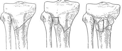 Fractures of the Proximal Tibia (Shinbone) | Omaha, Ne