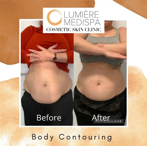 Hifu Body Contouring Lumiere Medispa Skin Health Rejuvenation Clinic