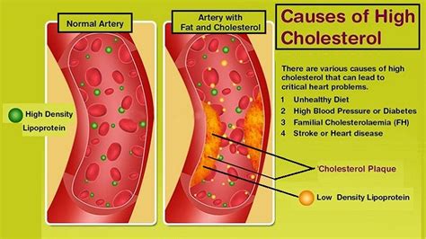 Increase In Cholesterol What Are Causing Factors Helal Medical