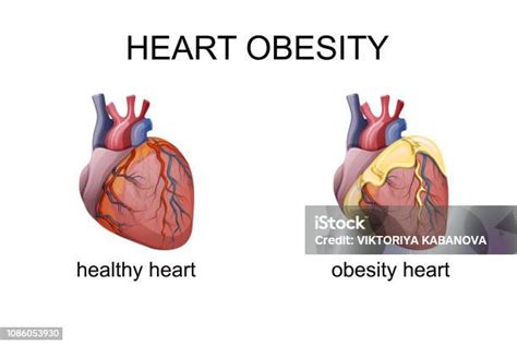 Obesity Heart Comparison Cardiology Stock Illustration Download Image