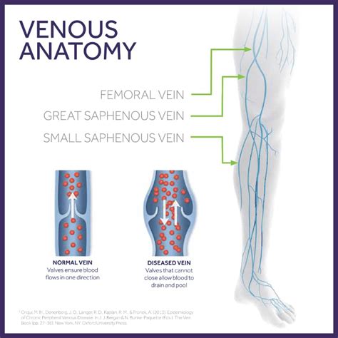 Chronic Venous Insufficiency Advanced Vein Care