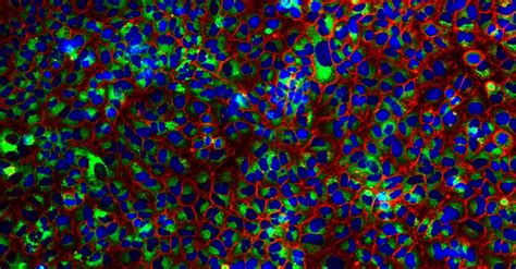 Understanding Lysosome Dysfunction in Neurodegenerative Diseases