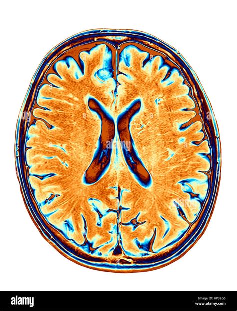 Cervello Normale Colorato Di Risonanza Magnetica Rm Scansione Di Una