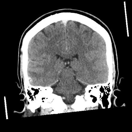 Neurocysticercosis Granular Nodular Image Radiopaedia Org