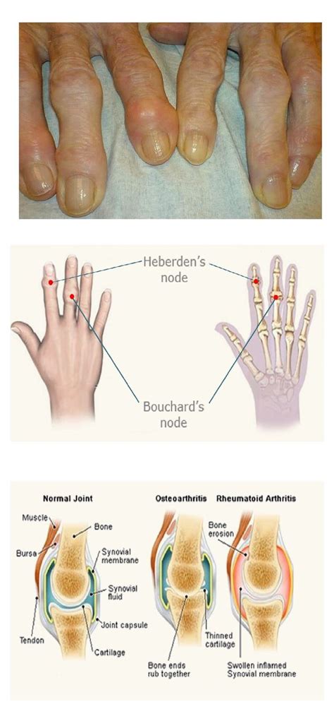 Heberden's nodes images | Osteoarthritis, Bone and joint, Synovial fluid