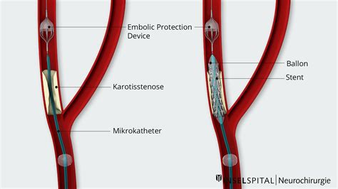 Stenose Der Arteria Carotis Pregnancy Informations