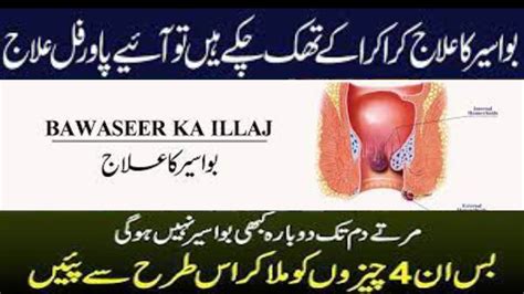 Bawaseer Ka Ilaj How To Get Rid Of Piles Hemorrhoids Causes Symptoms Treatment Bawasir Men