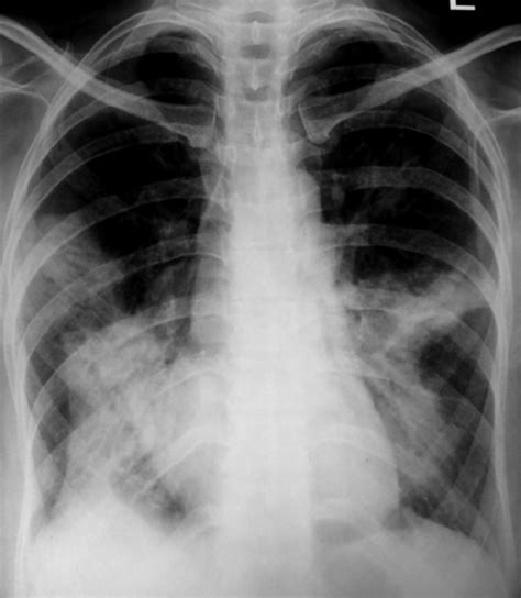 Chest Radiograph Reveals Multi Lobar Consolidation In Bilateral Lower Hot Sex Picture