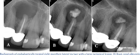 Figure 2 From Nonsurgical Endodontic Management Of Large Periapical