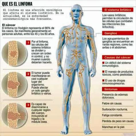 Sintomas De Cancer De Linfoma No Hodgkin Cancerwalls