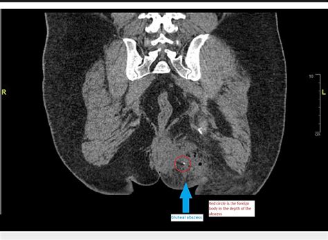 Figure 2 From Gluteal Abscess Secondary To Rectal Perforation Due To