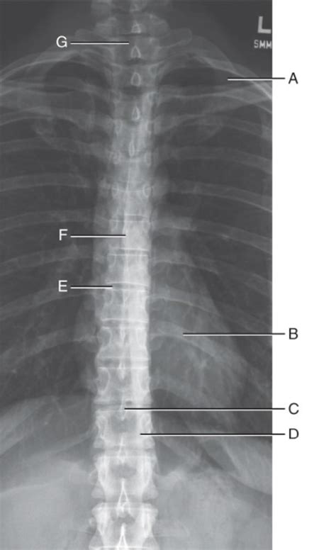 AP T Spine Diagram Quizlet