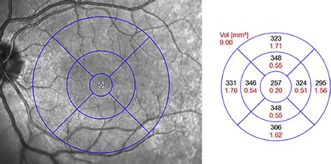 Hyperreflective Dots In The Avascular Outer Retina In Relapsing